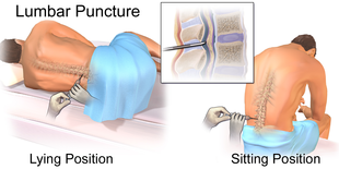 Lumbar puncture